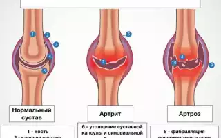 Какие дегенеративные изменения менисков коленного сустава существуют?