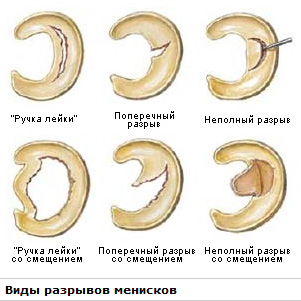 мениск коленного сустава