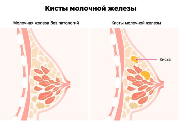 киста молочной железы